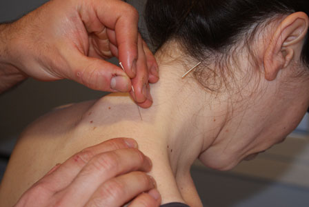 acupuntura en el cuello